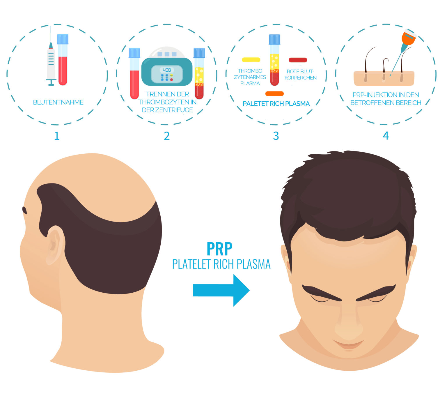 Eigenbluttherapie | C&B Hairtransplant