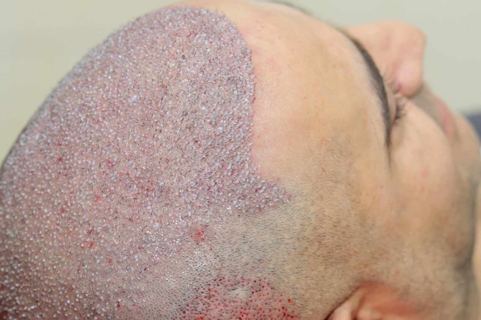 FUE Haartransplantation für Männer